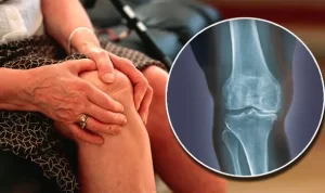 knee-osteoarthritis-symptoms